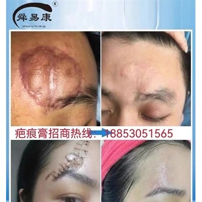 祛疤膏疤痕修复凝胶疤痕修复膏山东舜易康有限公司承接代加工产品